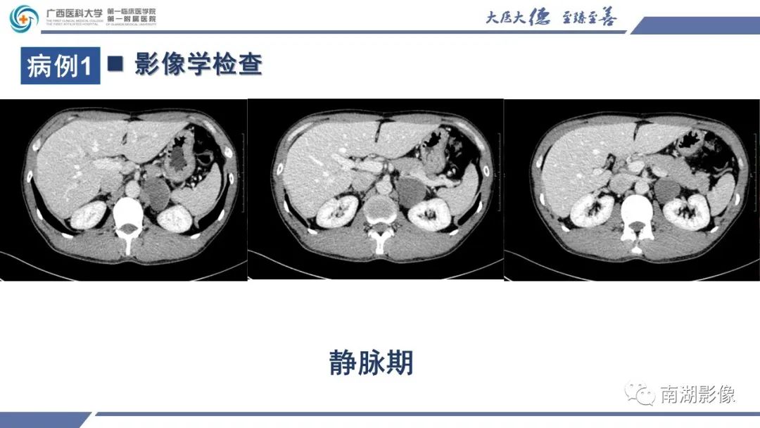 影像PPT - 【PPT】肾上腺节细胞神经瘤-5