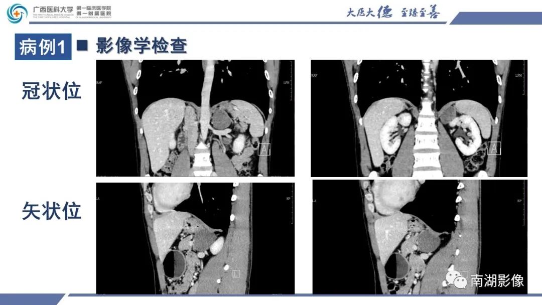 影像PPT - 【PPT】肾上腺节细胞神经瘤-6