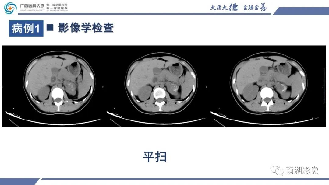 影像PPT - 【PPT】肾上腺节细胞神经瘤-8