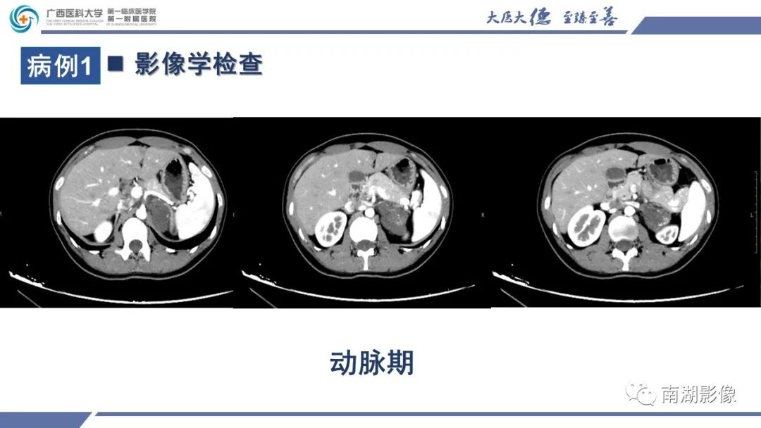 影像PPT - 【PPT】肾上腺节细胞神经瘤-9