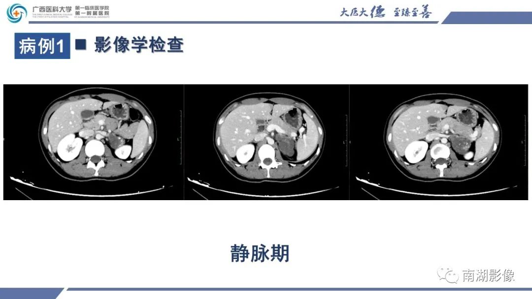 影像PPT - 【PPT】肾上腺节细胞神经瘤-10