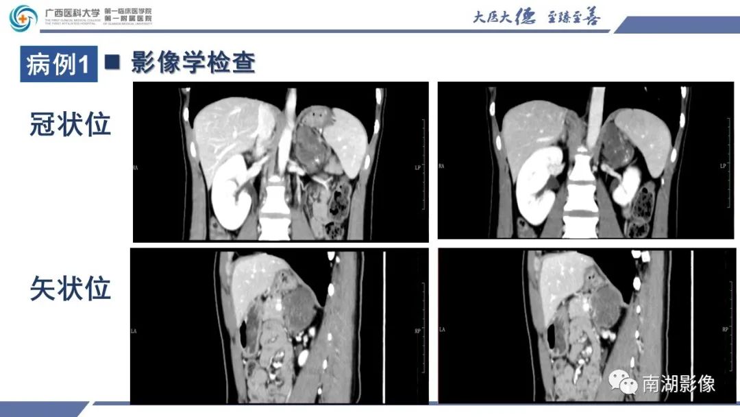 影像PPT - 【PPT】肾上腺节细胞神经瘤-11