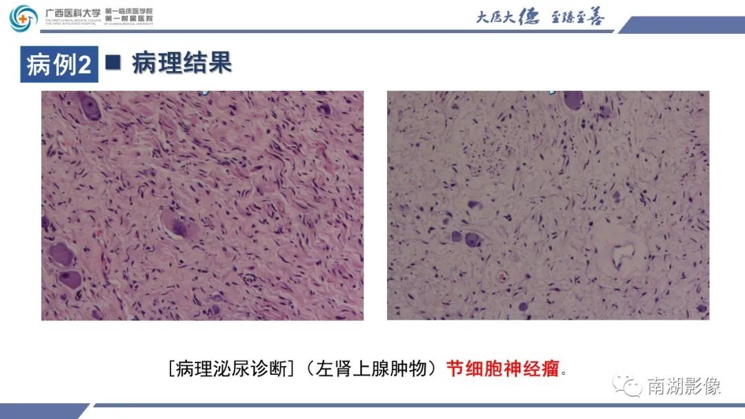 影像PPT - 【PPT】肾上腺节细胞神经瘤-13