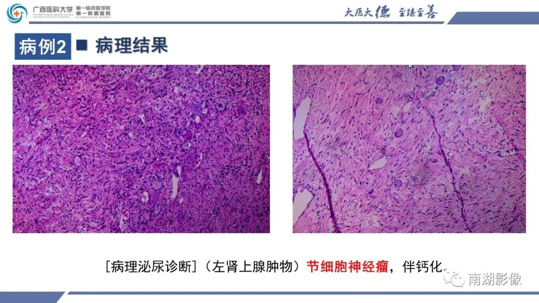 影像PPT - 【PPT】肾上腺节细胞神经瘤-14