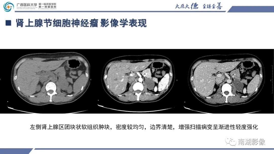影像PPT - 【PPT】肾上腺节细胞神经瘤-19
