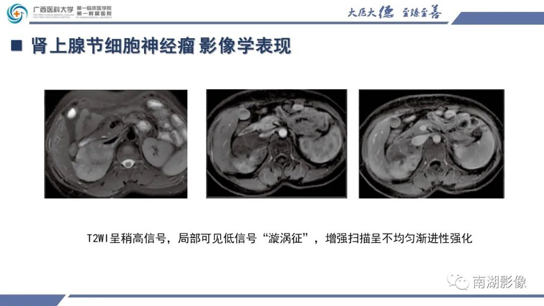 影像PPT - 【PPT】肾上腺节细胞神经瘤-21