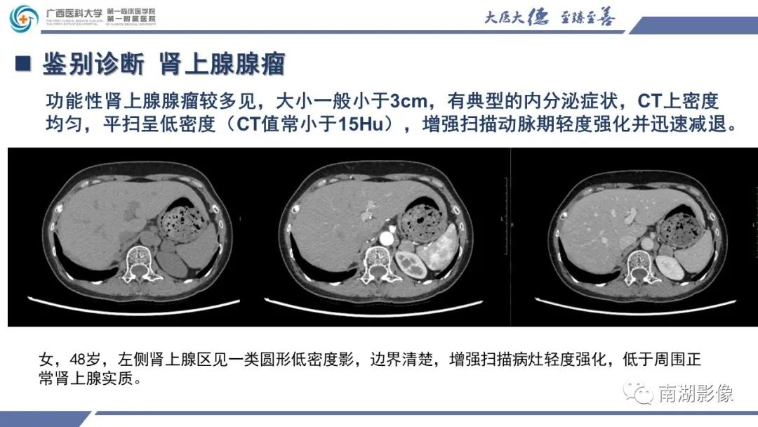 影像PPT - 【PPT】肾上腺节细胞神经瘤-23