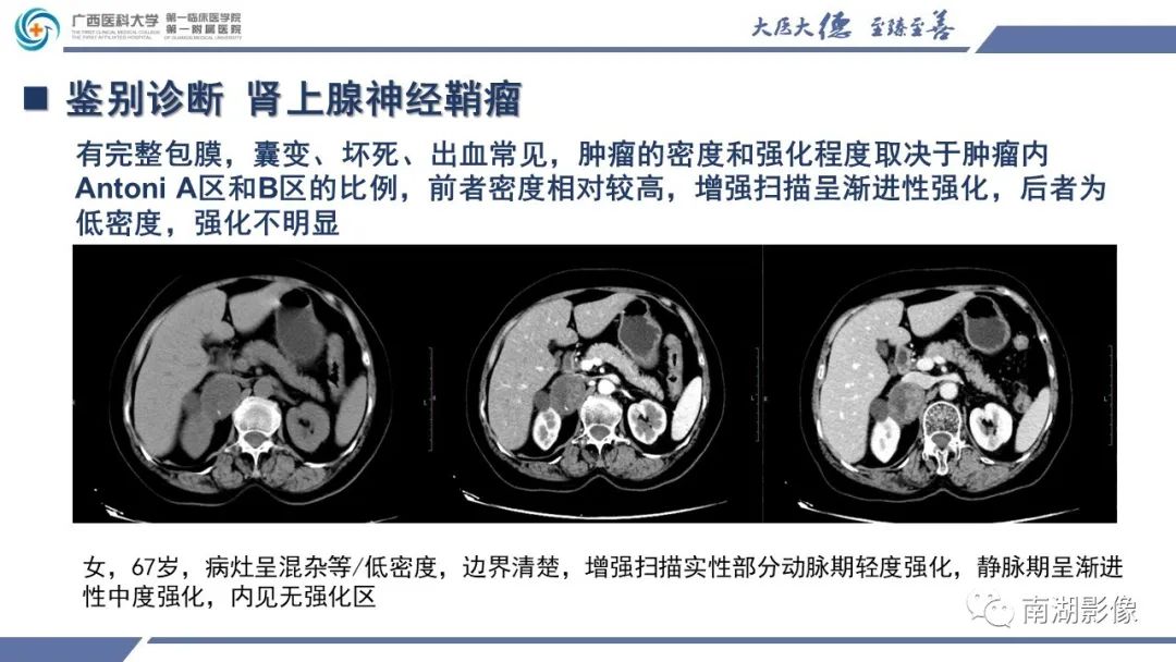 影像PPT - 【PPT】肾上腺节细胞神经瘤-24