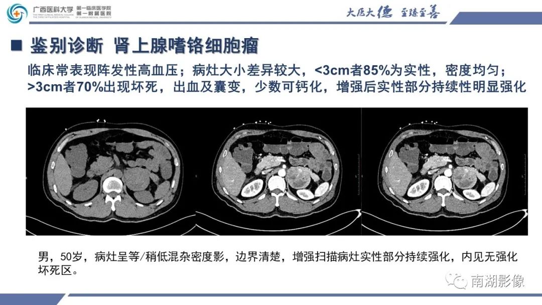 影像PPT - 【PPT】肾上腺节细胞神经瘤-25