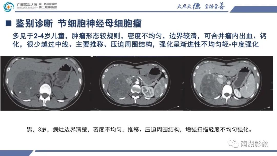 影像PPT - 【PPT】肾上腺节细胞神经瘤-26