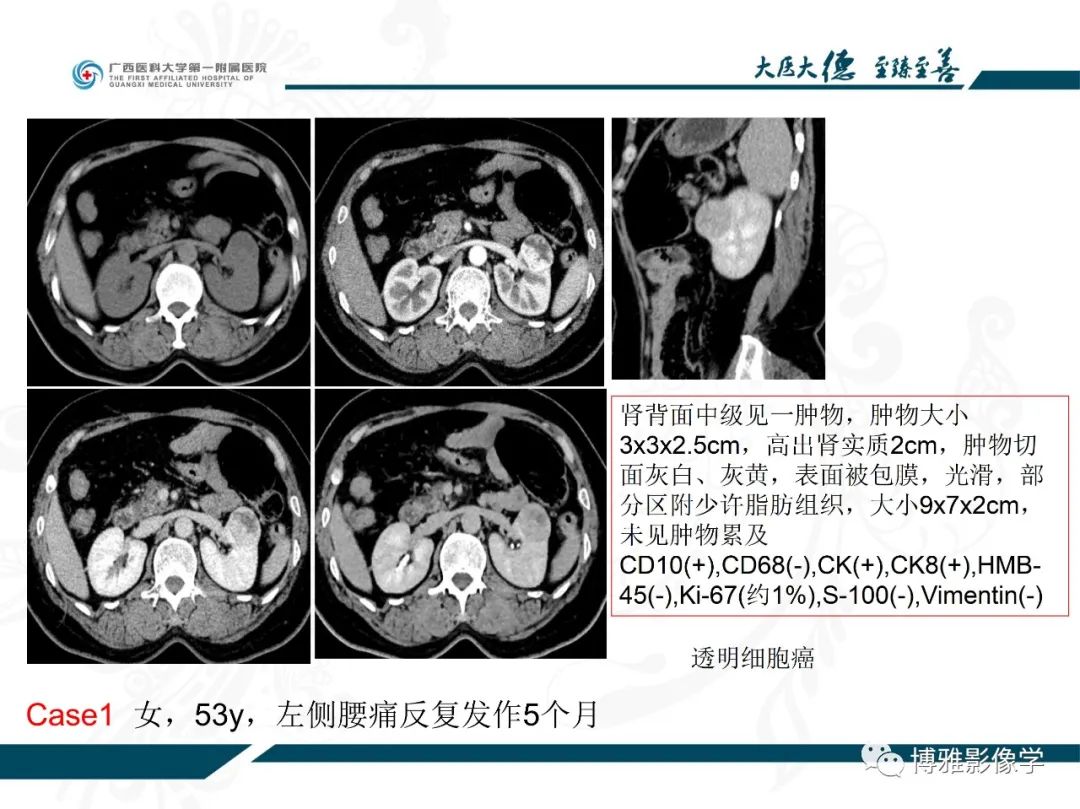 影像PPT - 【PPT】肾癌常见及少见征象的解读和鉴别诊断-2