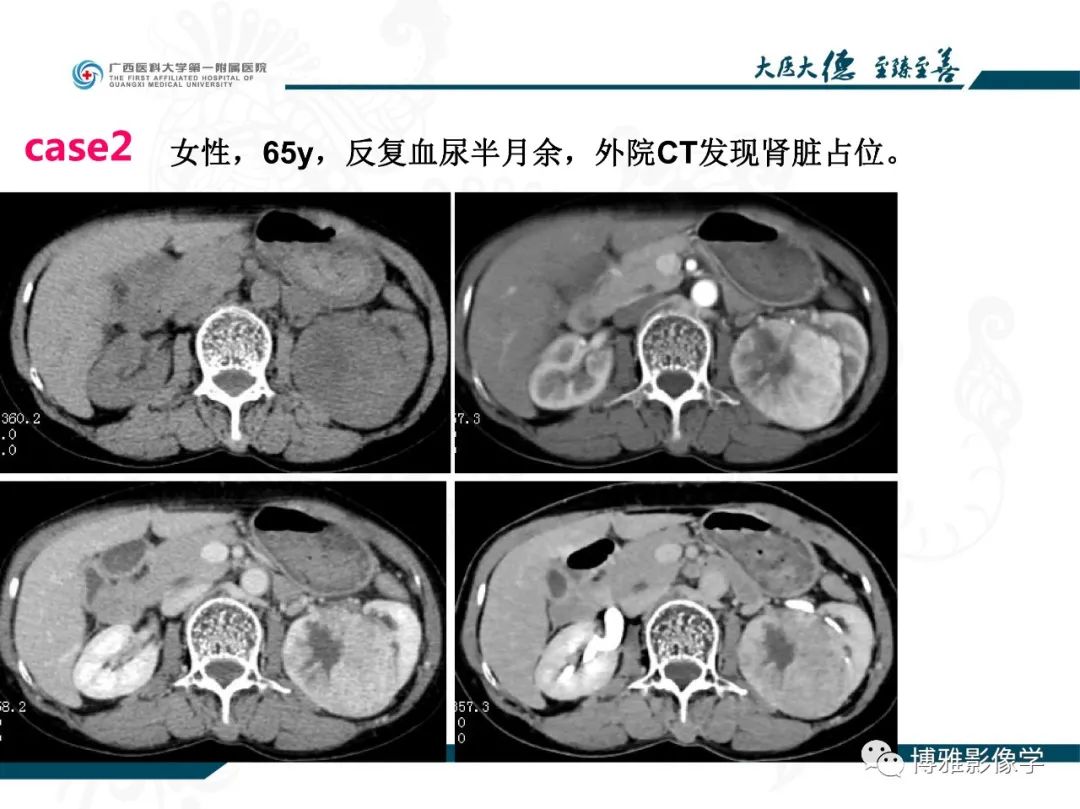 影像PPT - 【PPT】肾癌常见及少见征象的解读和鉴别诊断-3