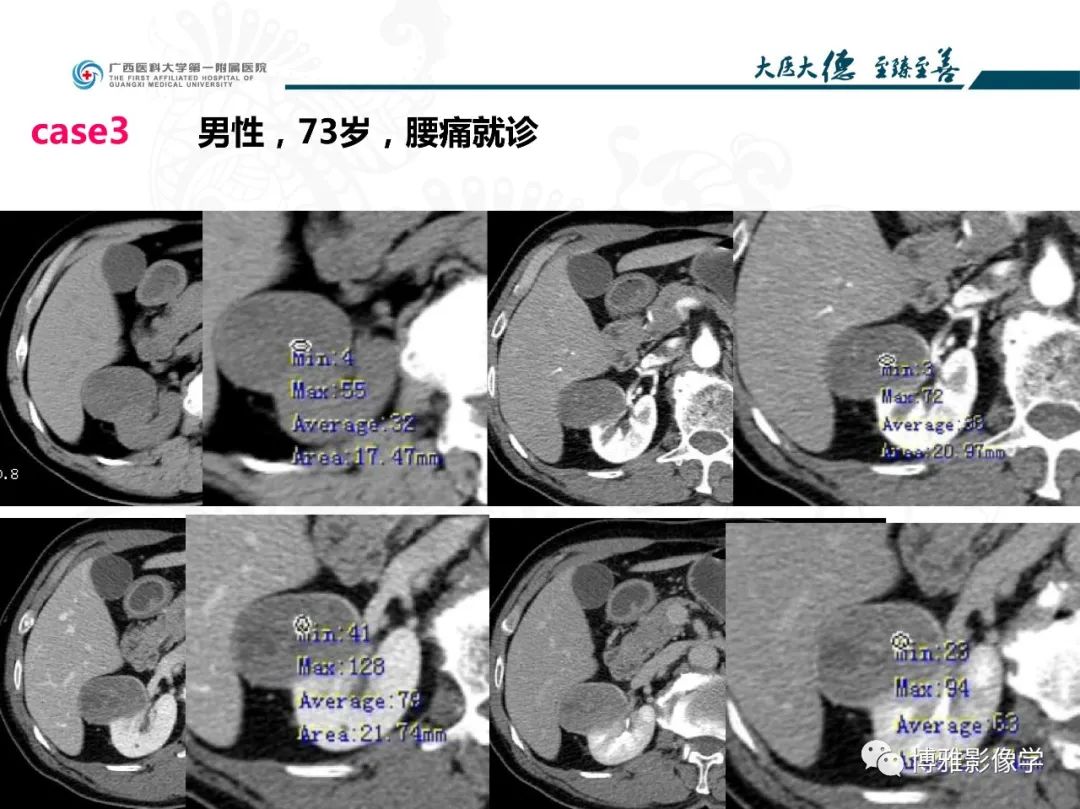 影像PPT - 【PPT】肾癌常见及少见征象的解读和鉴别诊断-5