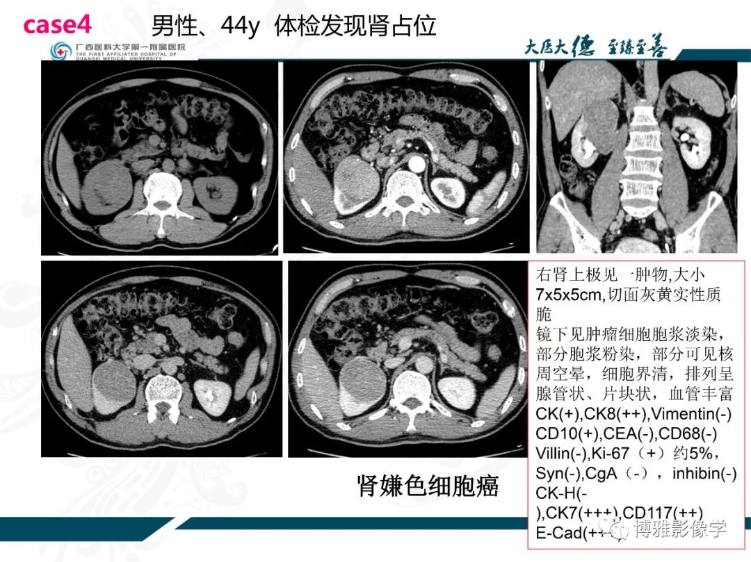 影像PPT - 【PPT】肾癌常见及少见征象的解读和鉴别诊断-7
