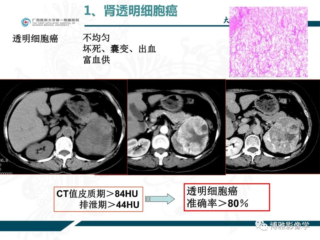 影像PPT - 【PPT】肾癌常见及少见征象的解读和鉴别诊断-12