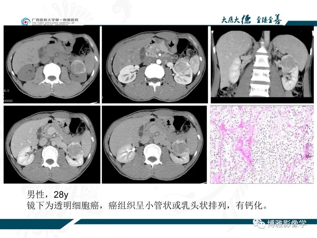 影像PPT - 【PPT】肾癌常见及少见征象的解读和鉴别诊断-14