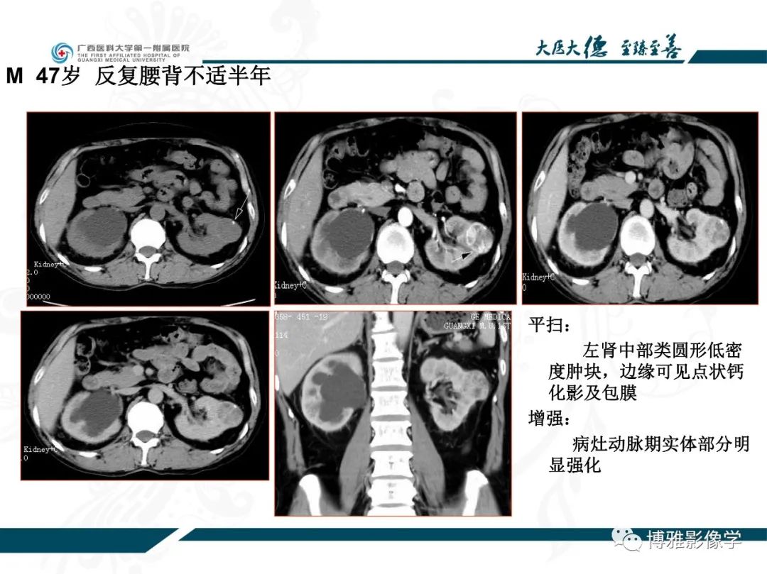 影像PPT - 【PPT】肾癌常见及少见征象的解读和鉴别诊断-13