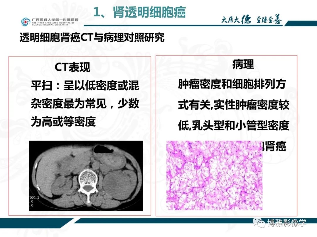 影像PPT - 【PPT】肾癌常见及少见征象的解读和鉴别诊断-15