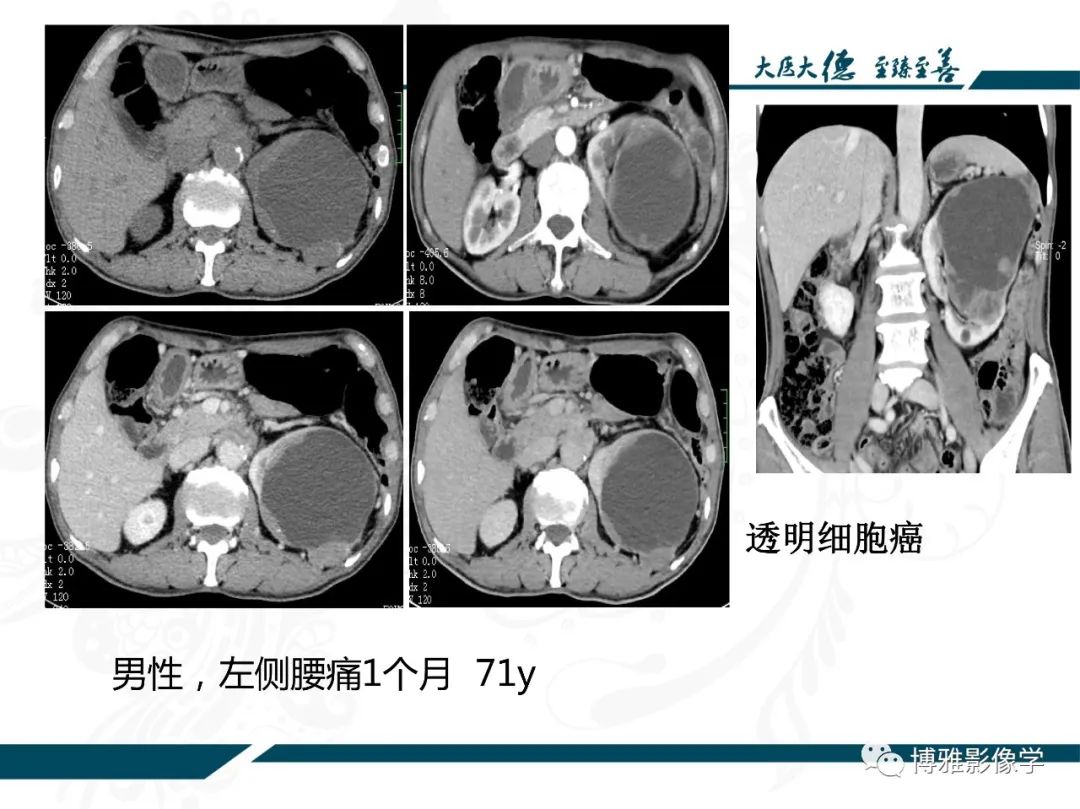 影像PPT - 【PPT】肾癌常见及少见征象的解读和鉴别诊断-17