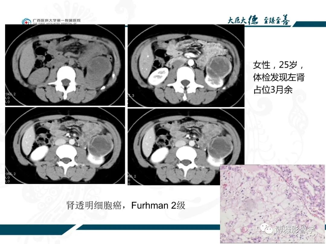 影像PPT - 【PPT】肾癌常见及少见征象的解读和鉴别诊断-20