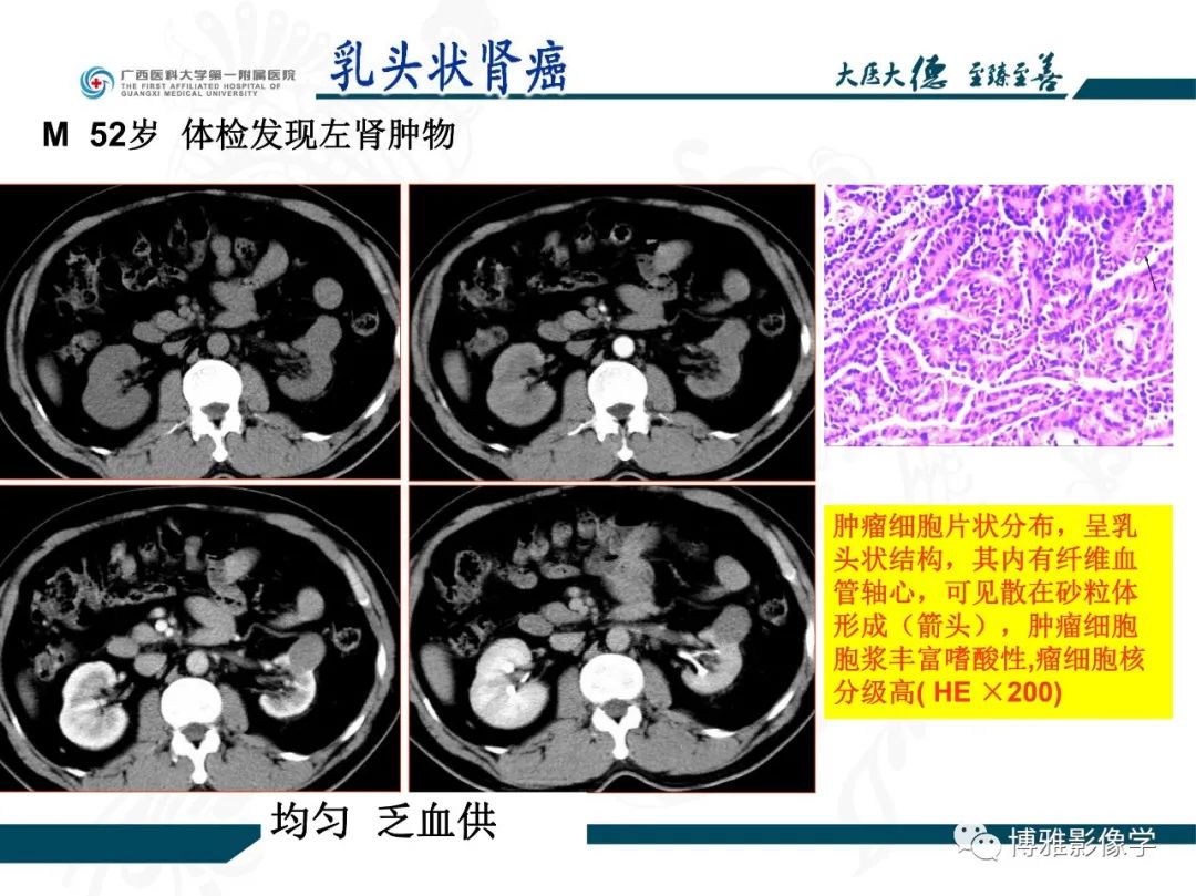 影像PPT - 【PPT】肾癌常见及少见征象的解读和鉴别诊断-22