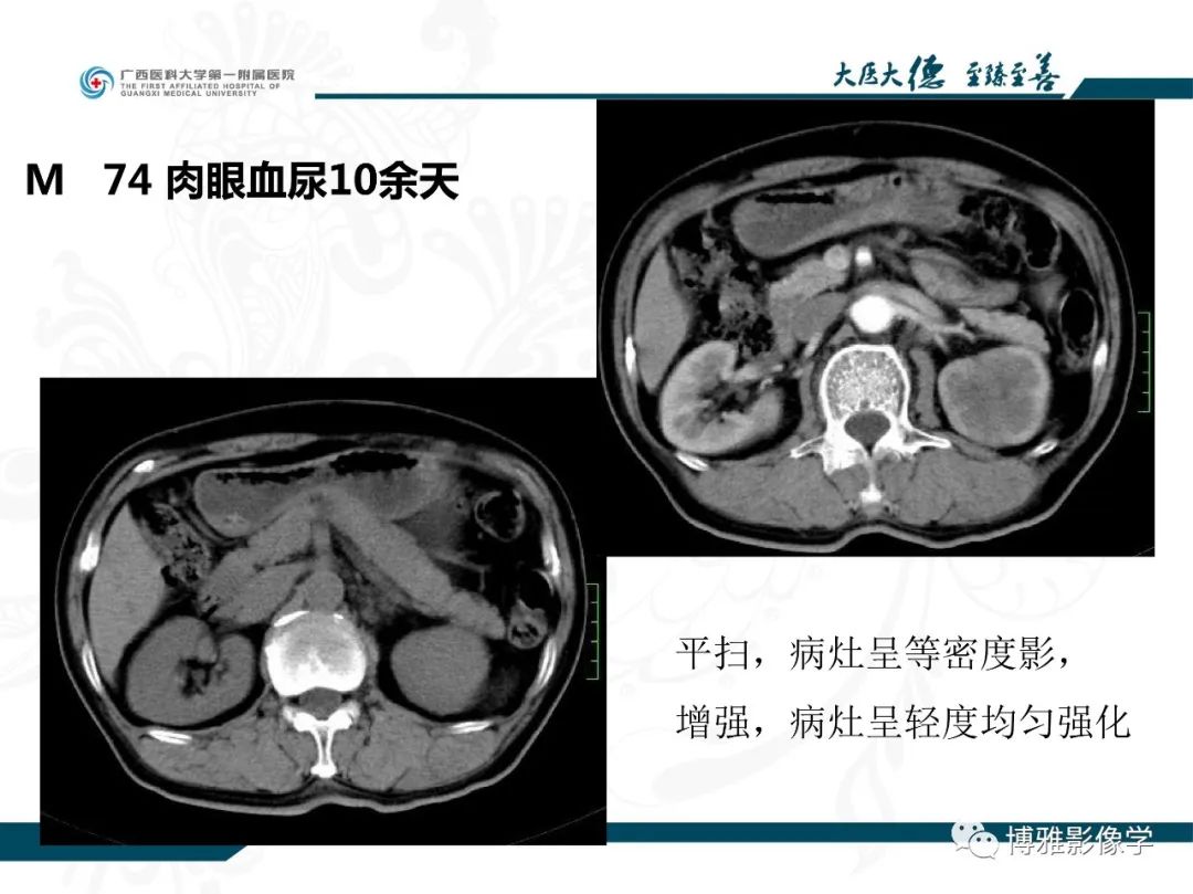 影像PPT - 【PPT】肾癌常见及少见征象的解读和鉴别诊断-23