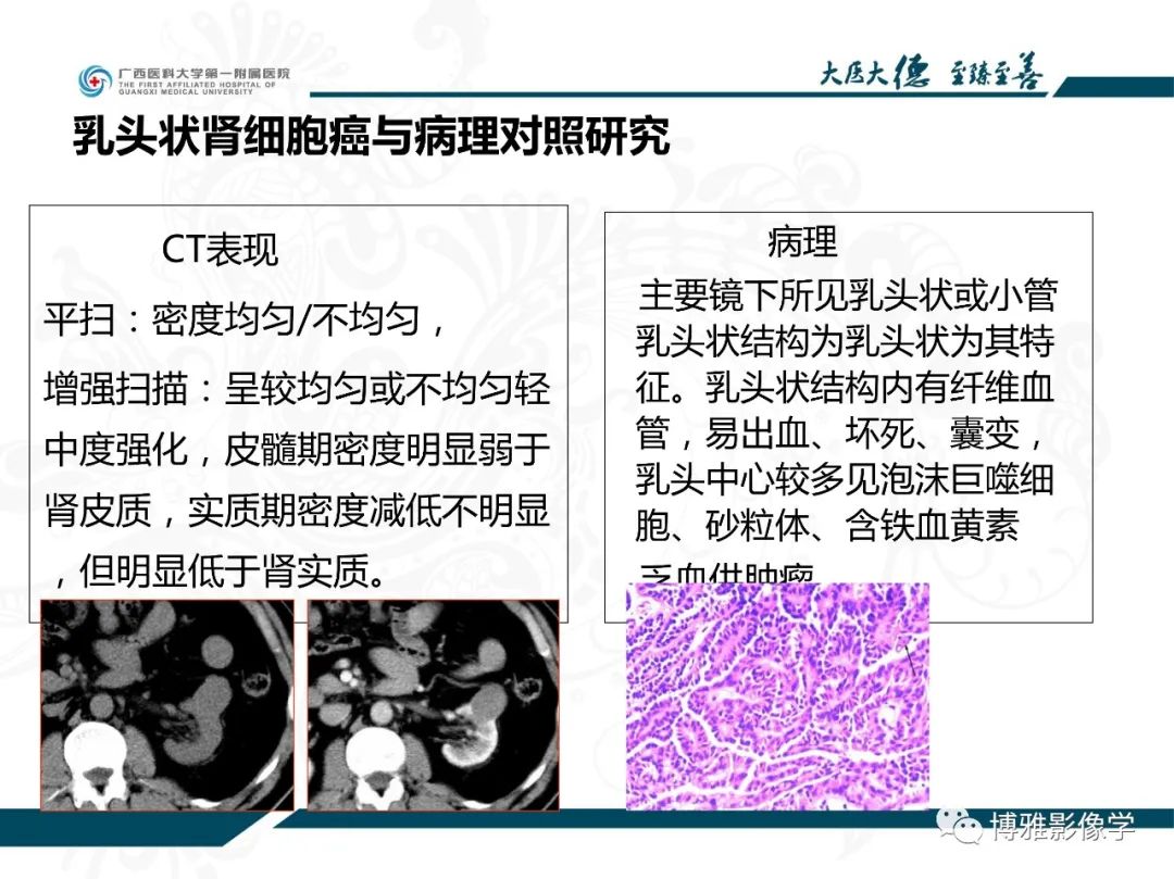 影像PPT - 【PPT】肾癌常见及少见征象的解读和鉴别诊断-25