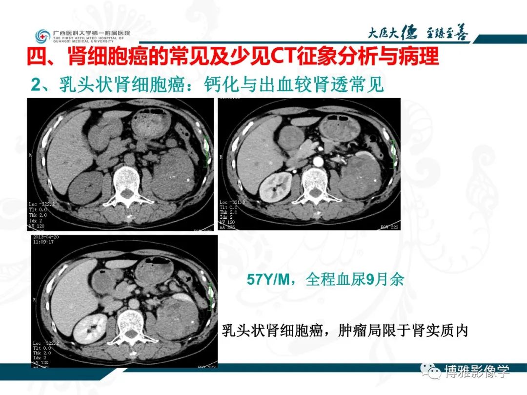 影像PPT - 【PPT】肾癌常见及少见征象的解读和鉴别诊断-26