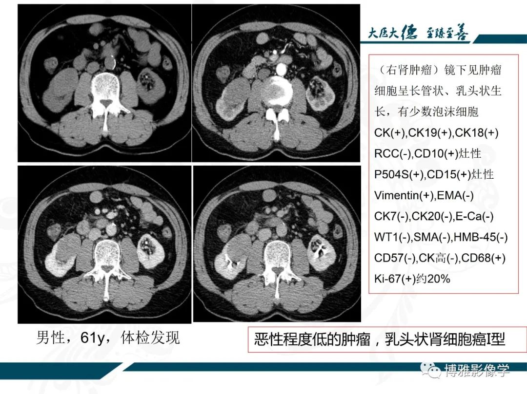 影像PPT - 【PPT】肾癌常见及少见征象的解读和鉴别诊断-27