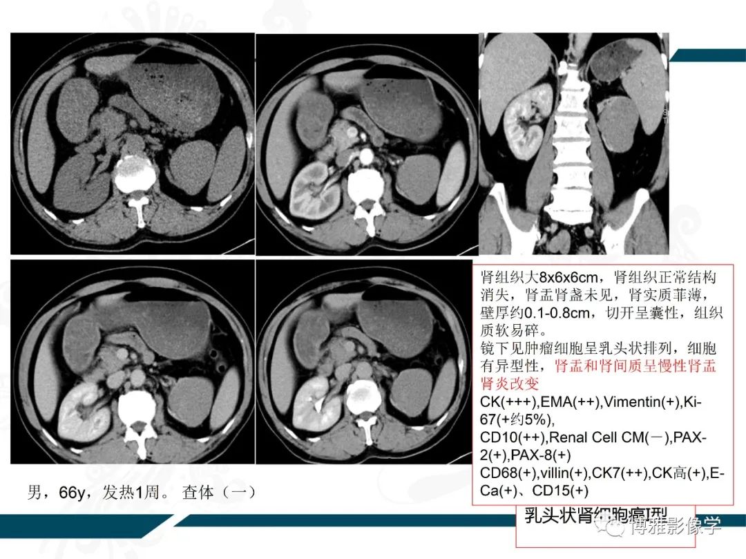 影像PPT - 【PPT】肾癌常见及少见征象的解读和鉴别诊断-28