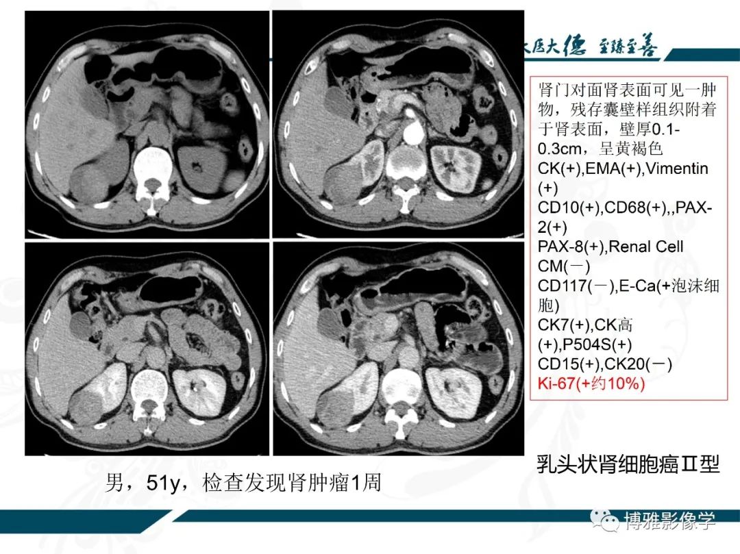 影像PPT - 【PPT】肾癌常见及少见征象的解读和鉴别诊断-29