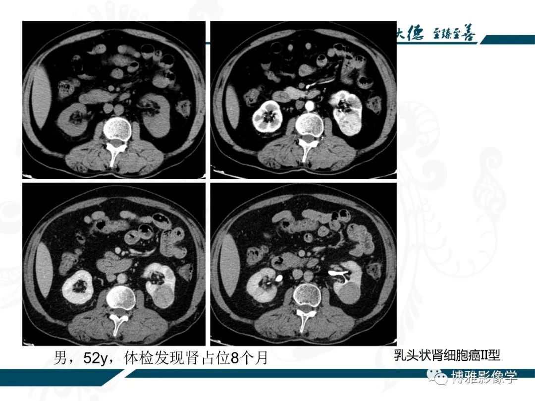 影像PPT - 【PPT】肾癌常见及少见征象的解读和鉴别诊断-30