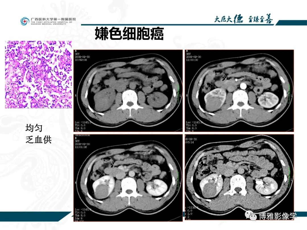 影像PPT - 【PPT】肾癌常见及少见征象的解读和鉴别诊断-33