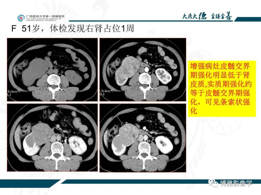 影像PPT - 【PPT】肾癌常见及少见征象的解读和鉴别诊断-34