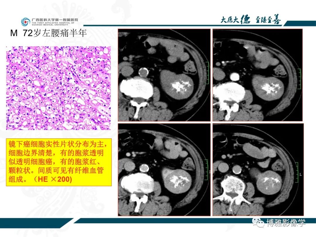 影像PPT - 【PPT】肾癌常见及少见征象的解读和鉴别诊断-35