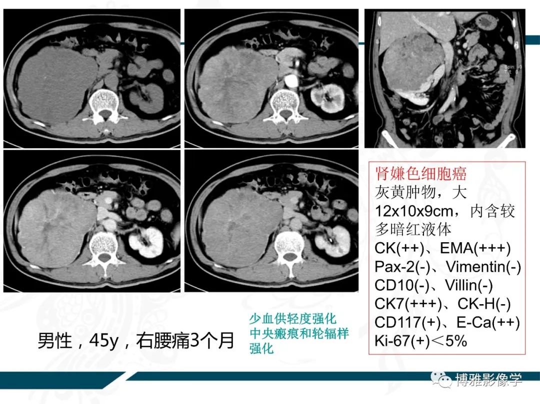 影像PPT - 【PPT】肾癌常见及少见征象的解读和鉴别诊断-38