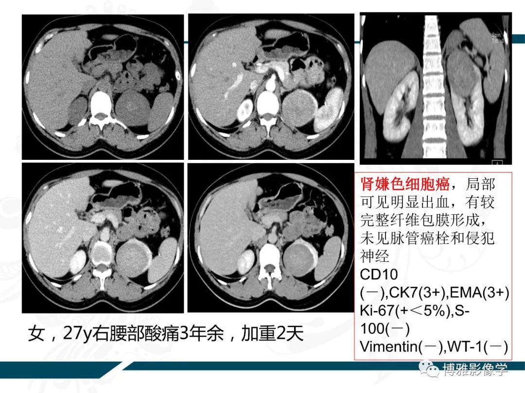 影像PPT - 【PPT】肾癌常见及少见征象的解读和鉴别诊断-39