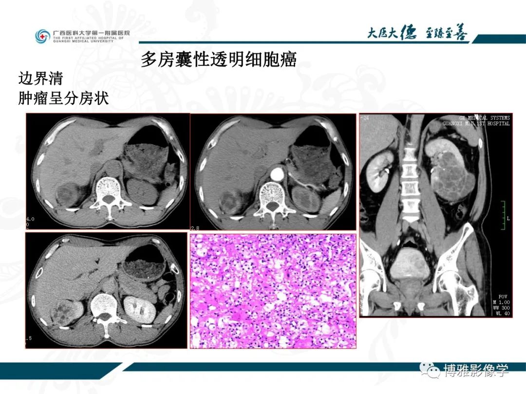 影像PPT - 【PPT】肾癌常见及少见征象的解读和鉴别诊断-43