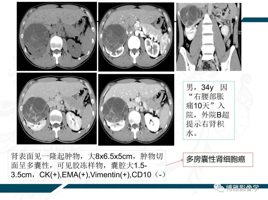 影像PPT - 【PPT】肾癌常见及少见征象的解读和鉴别诊断-44