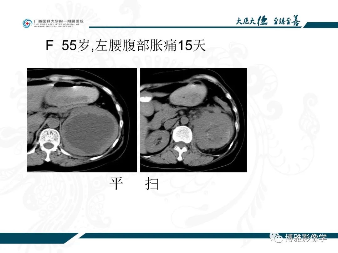 影像PPT - 【PPT】肾癌常见及少见征象的解读和鉴别诊断-46
