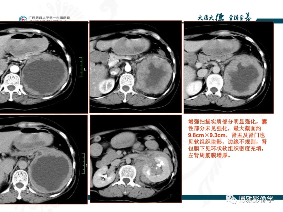 影像PPT - 【PPT】肾癌常见及少见征象的解读和鉴别诊断-47