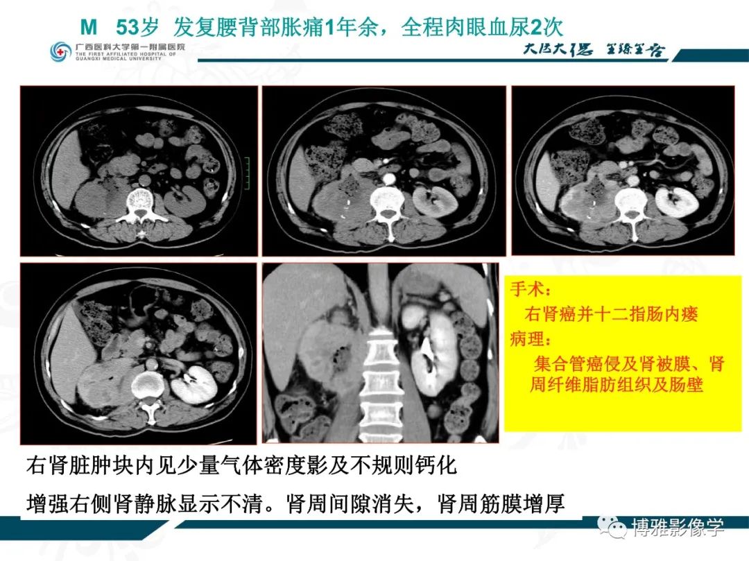 影像PPT - 【PPT】肾癌常见及少见征象的解读和鉴别诊断-48