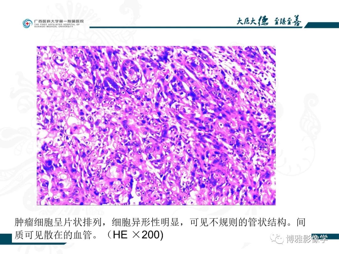 影像PPT - 【PPT】肾癌常见及少见征象的解读和鉴别诊断-49