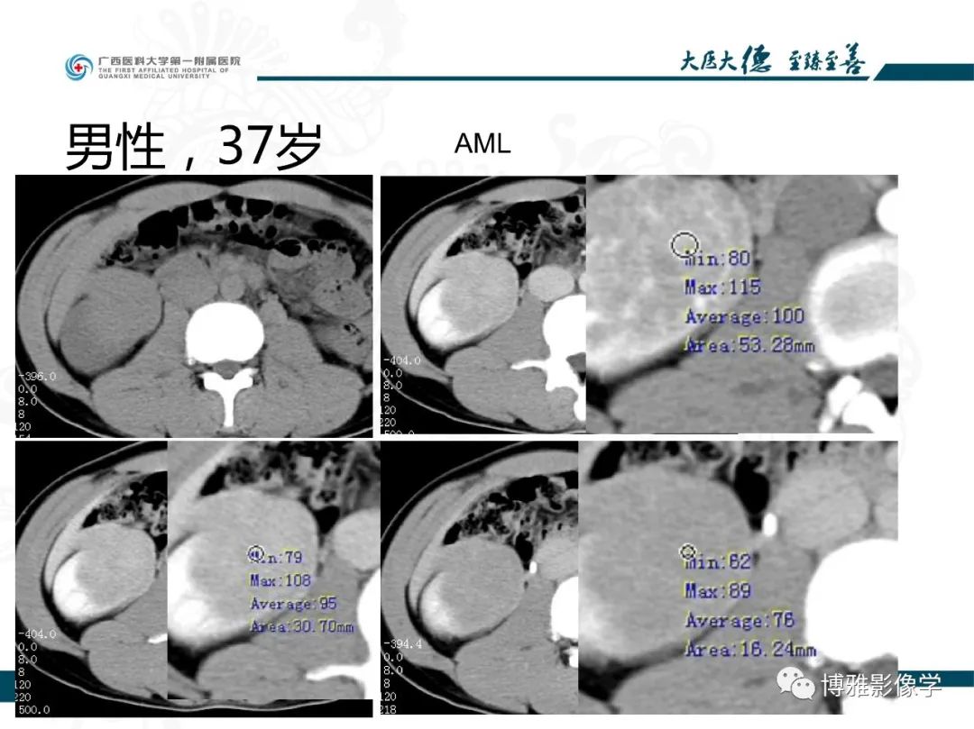 影像PPT - 【PPT】肾癌常见及少见征象的解读和鉴别诊断-53