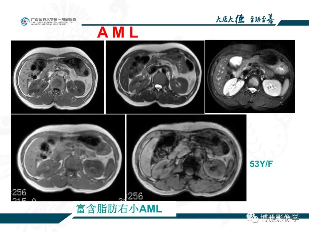 影像PPT - 【PPT】肾癌常见及少见征象的解读和鉴别诊断-55