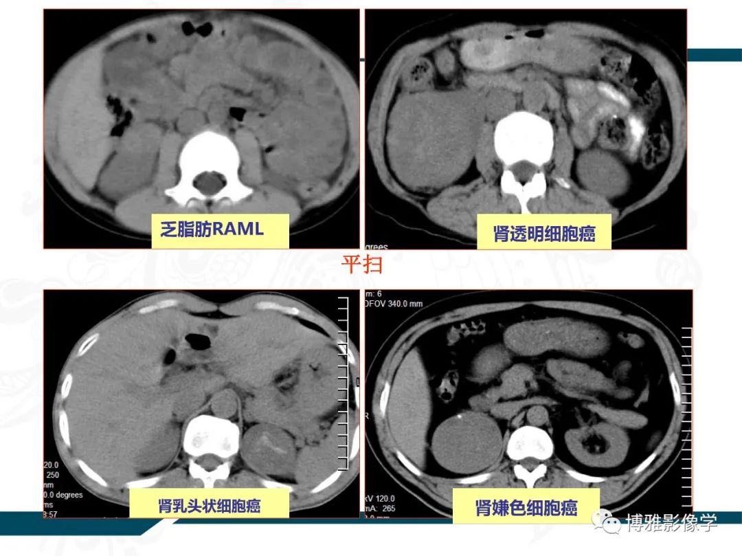 影像PPT - 【PPT】肾癌常见及少见征象的解读和鉴别诊断-58