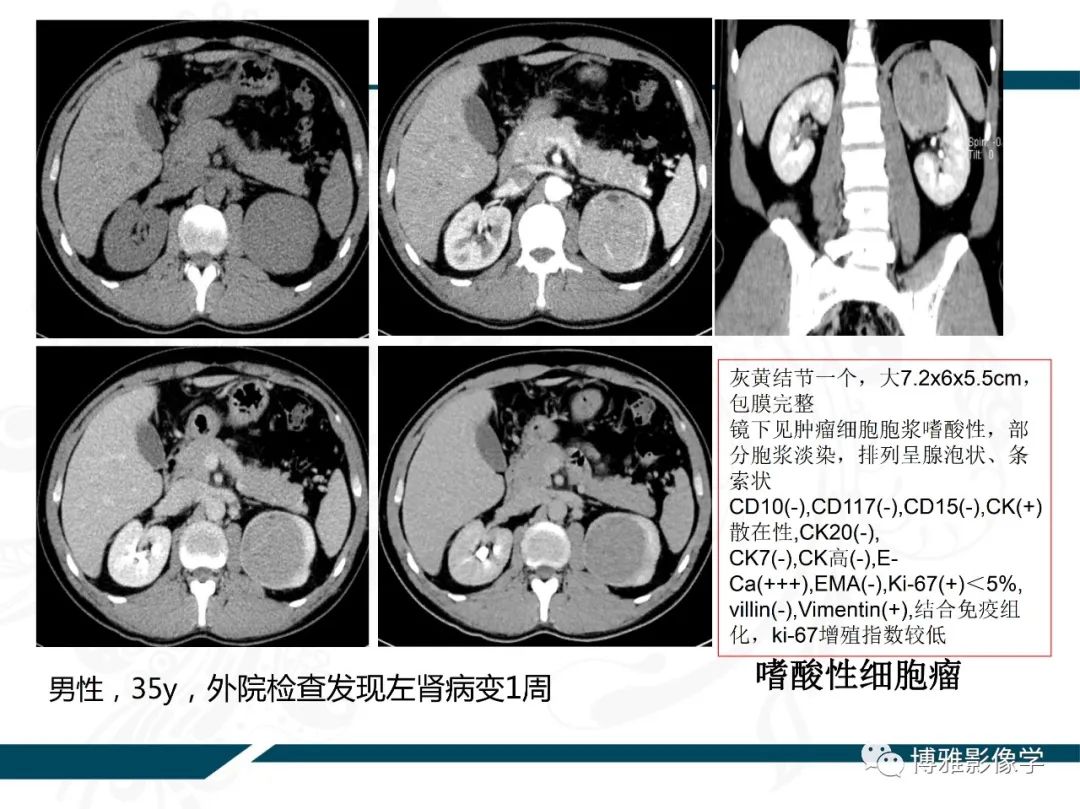 影像PPT - 【PPT】肾癌常见及少见征象的解读和鉴别诊断-63