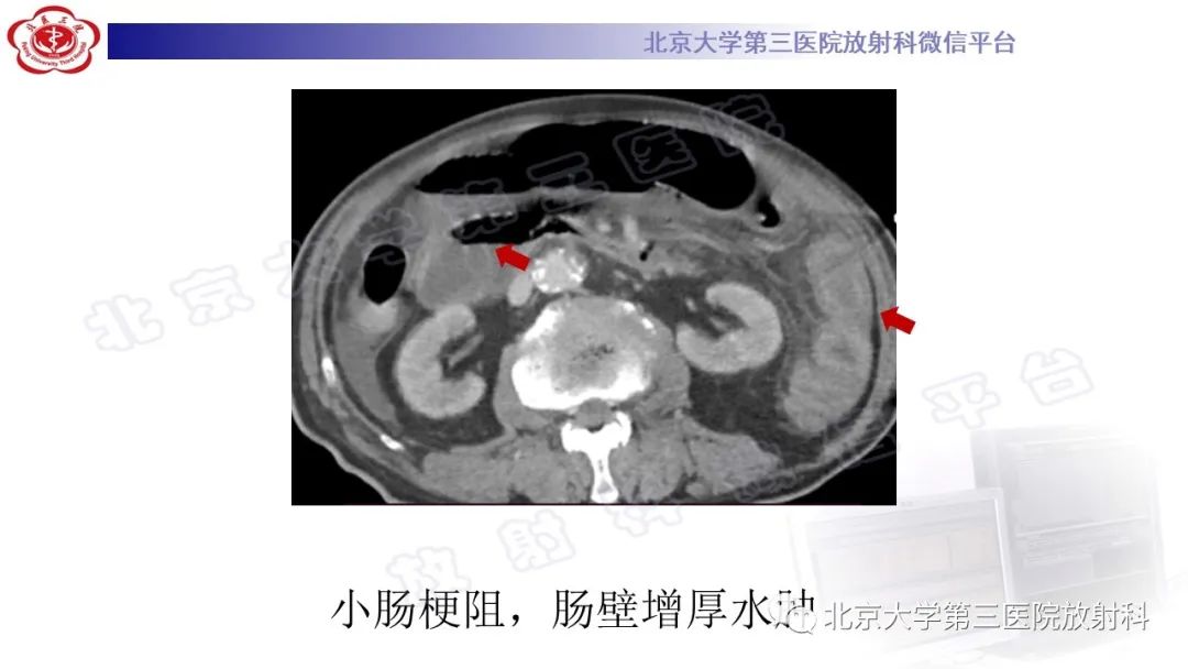 影像PPT - 【PPT】肠气囊肿症-4