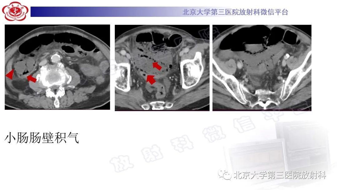 影像PPT - 【PPT】肠气囊肿症-5