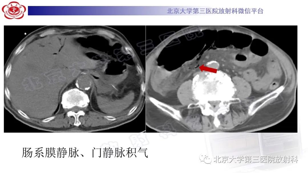 影像PPT - 【PPT】肠气囊肿症-6